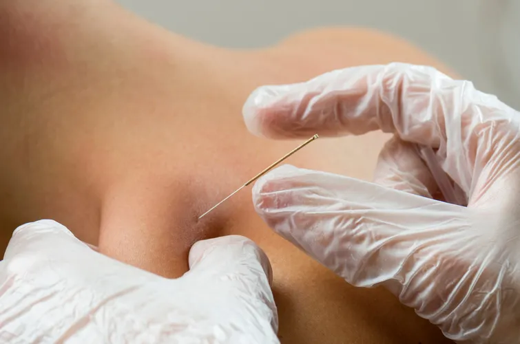 Dry-Needling