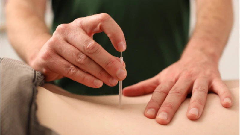 Dry-Needling